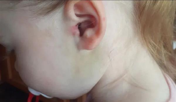 طبيب يعثر على قرادتين داخل أذن طفلة.. وصدمة تصيب الأم