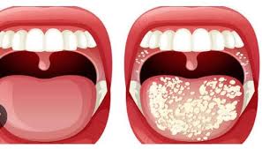 فطريات الفم والأسنان وطرق الحماية من أخطارها على الجسم